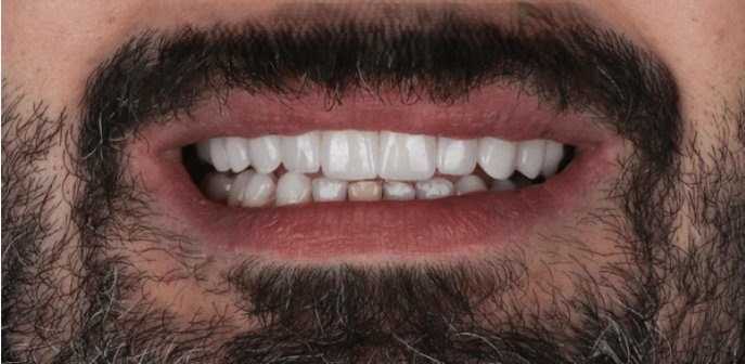 Dopo — sorriso sistemato