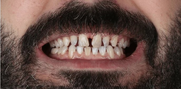 Prima — denti storti
